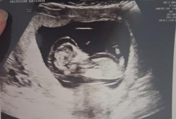 12 week scan of baby boy number two before his termination for medical reasons (TFMR).