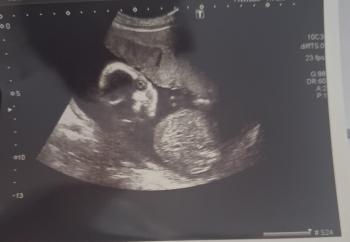 Olly’s scan before his mum had a termination for medical reasons (TFMR).