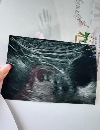 Scan picture of a baby who was lost during a miscarriage.