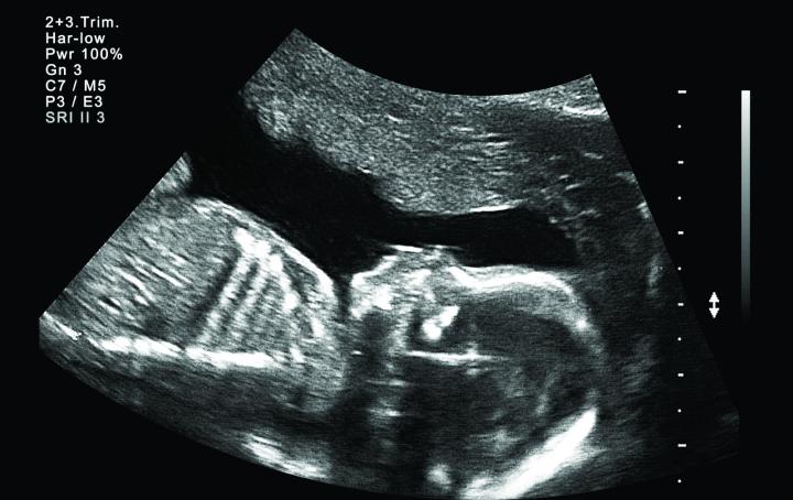 post mortem baby death 